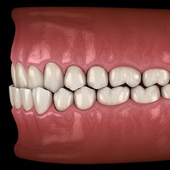 Illustration of an underbite
