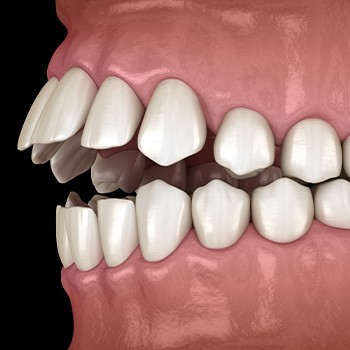 Illustration of an open bite