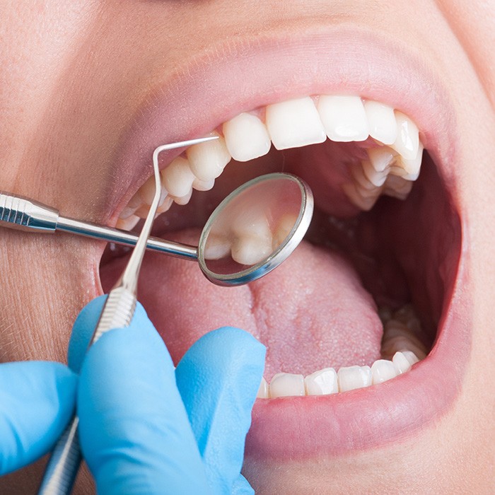 A closeup of a mouth receiving a dental cleaning