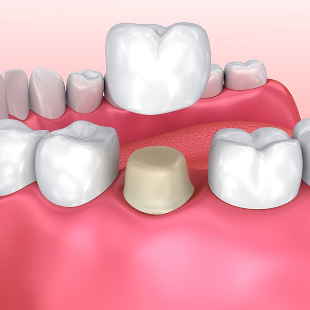 Model of dental crown over prepped tooth