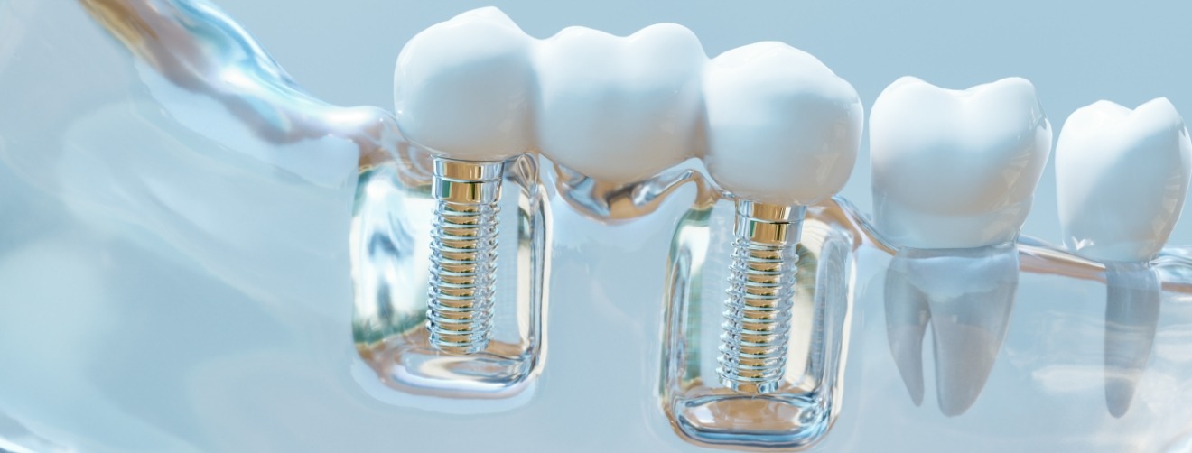 Model of the mouth with two dental implants in Athens replacing missing teeth