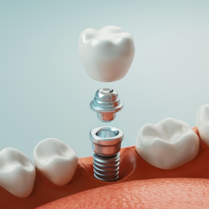 Illustrated dental crown and abutment being placed on a dental implant