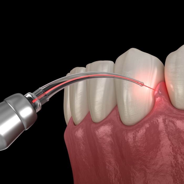 Illustrated dental laser treating gums