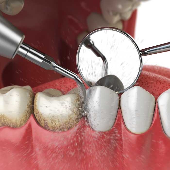 Illustrated dental instruments cleaning plaque buildup from teeth and gums