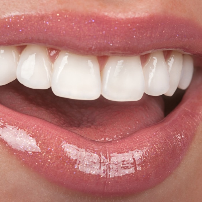 Close up of smile with flawless straight white teeth