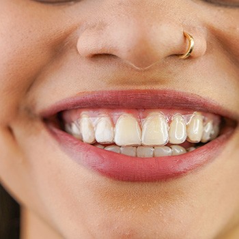 Closeup of woman’s smile with invisible aligners