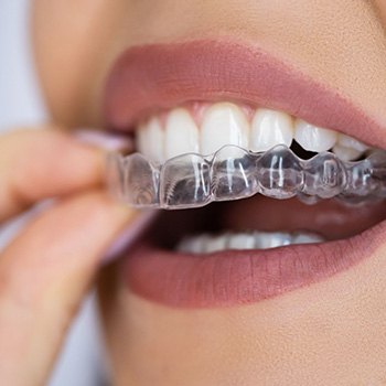 Woman removing SureSmile from upper arch