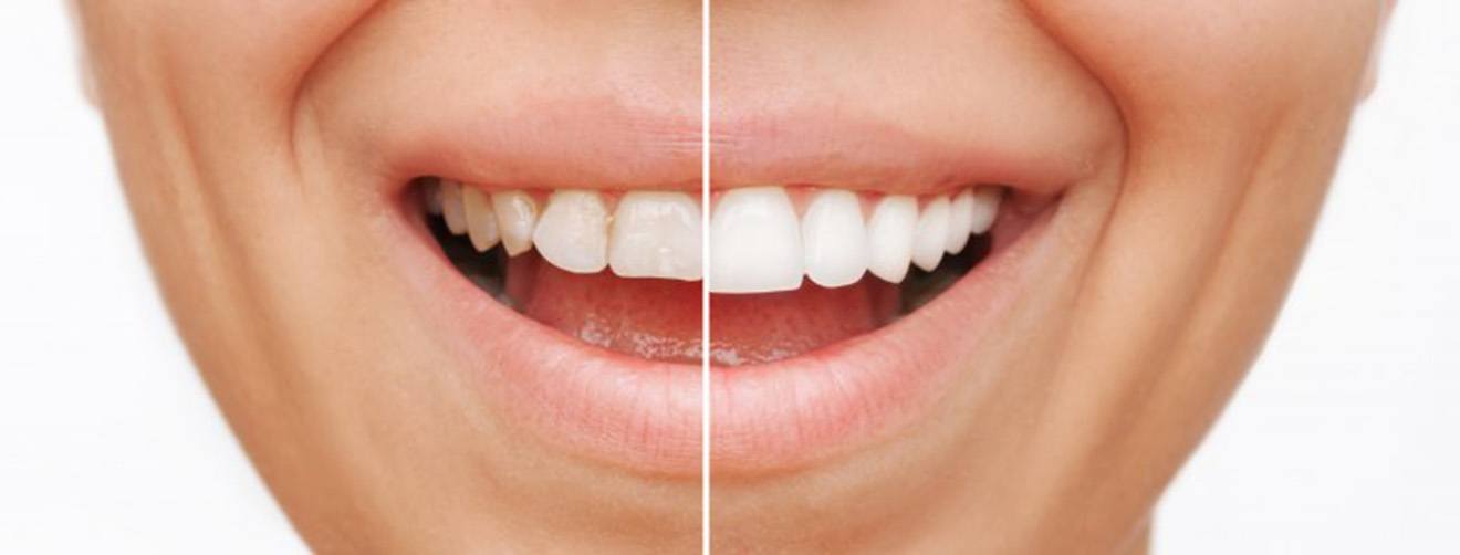 Before and after shot of a woman’s dental veneers 